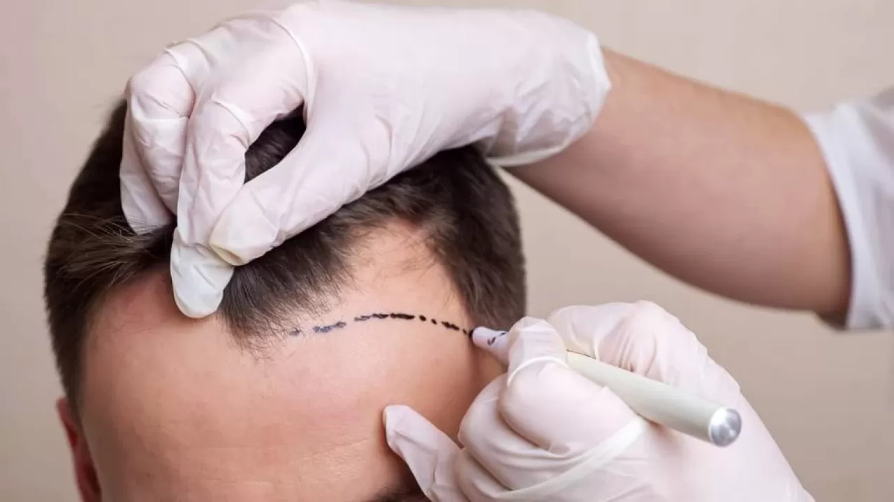 Sapphire Hair Transplant: Fast Recovery and Natural Results