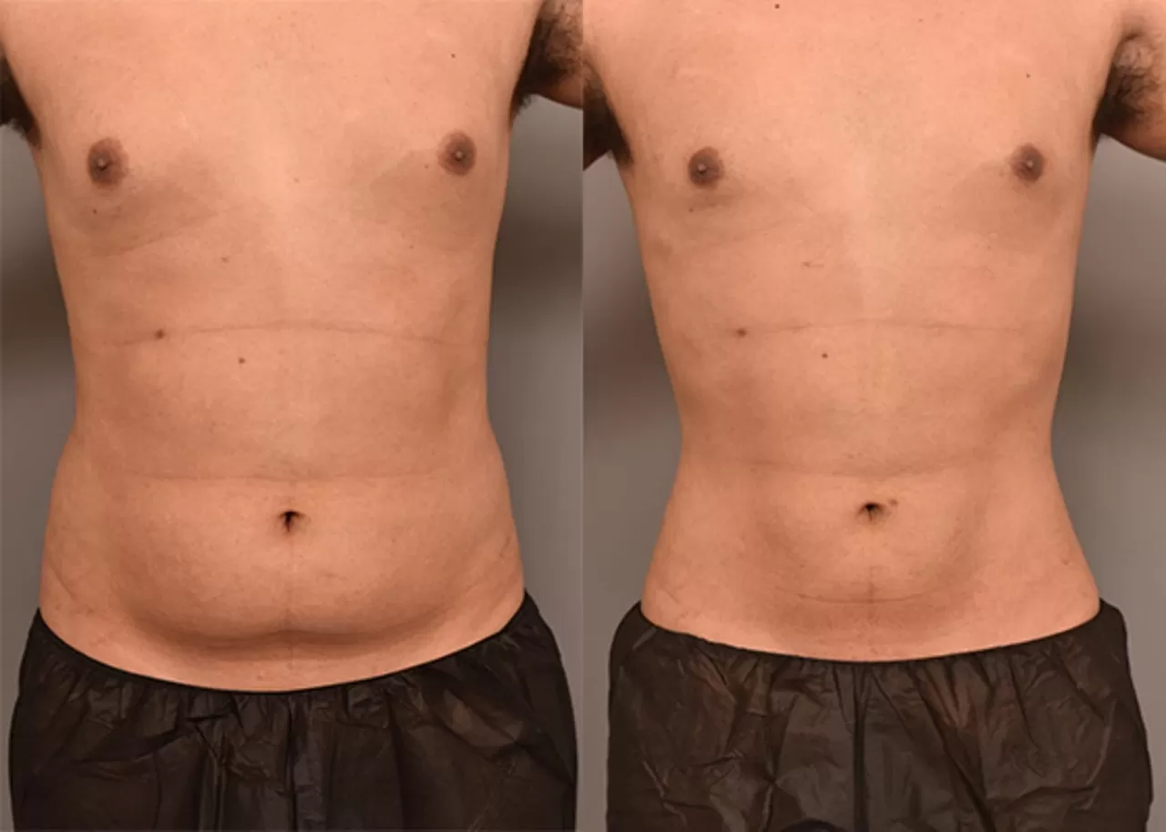 Liposuction: Benefits, Risks, and What to Expect