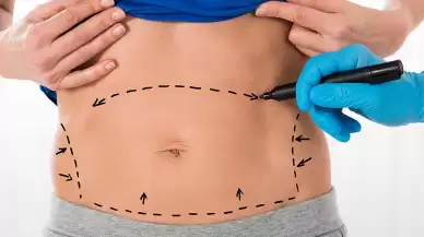 Abdominoplasty (Tummy Tuck): Procedure, Benefits, and Risks