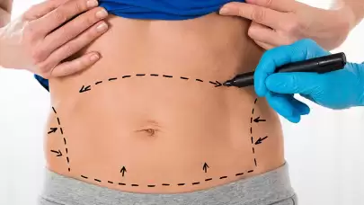 Abdominoplasty (Tummy Tuck): Procedure, Benefits, and Risks