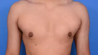 Gynecomastia: Causes, Treatment, and Key Information