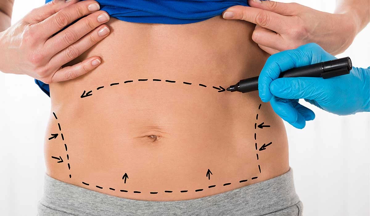 Abdominoplasty (Tummy Tuck): Procedure, Benefits, and Risks