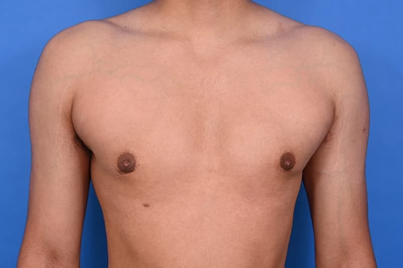 Gynecomastia: Causes, Treatment, and Key Information